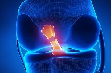 ACL Tear Surgery in Sikar | Advanced Orthopedic Care 2026