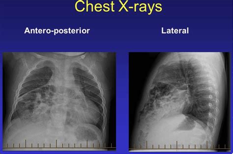 #CBCLIPS Episode 15: Boy with Trisomy 21, URI symptoms, and abnormal ...