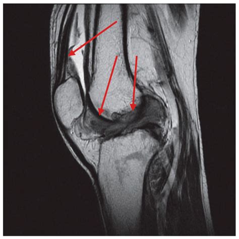 Diffuse-Type Tenosynovial Giant Cell Tumor of the Knee: Clinical Course ...
