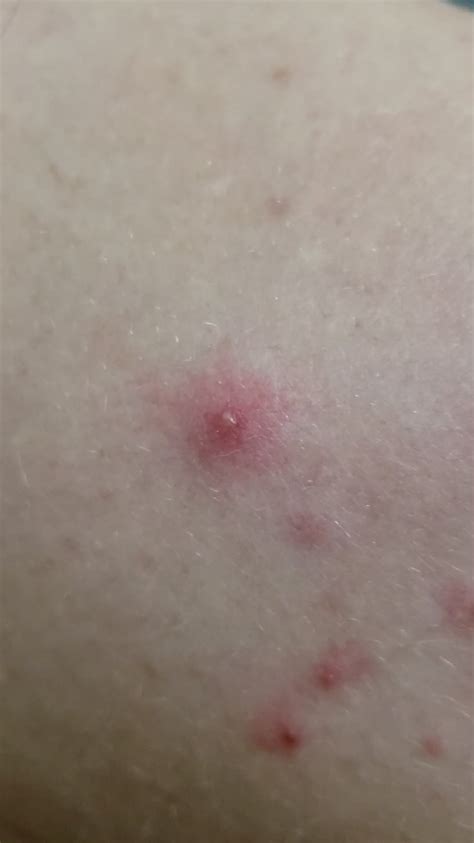 Image result for Exploding Back Zits