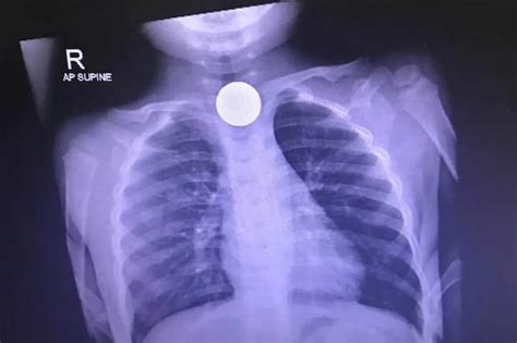 Batang nakalunok ng barya, nakaligtas | ABS-CBN News