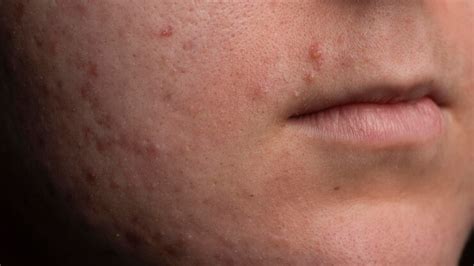 Skin health problem skin diseases skin acne background closeup acne ...