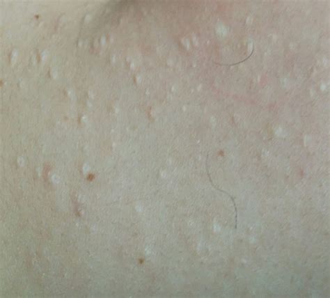 Bumps On Back