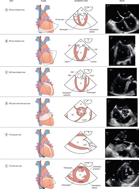 Echocardiographic anatomy of the heart - Clinical Tree