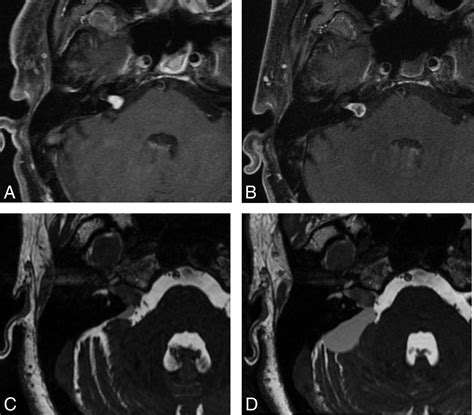The Management and Imaging of Vestibular Schwannomas | American Journal of Neuroradiology