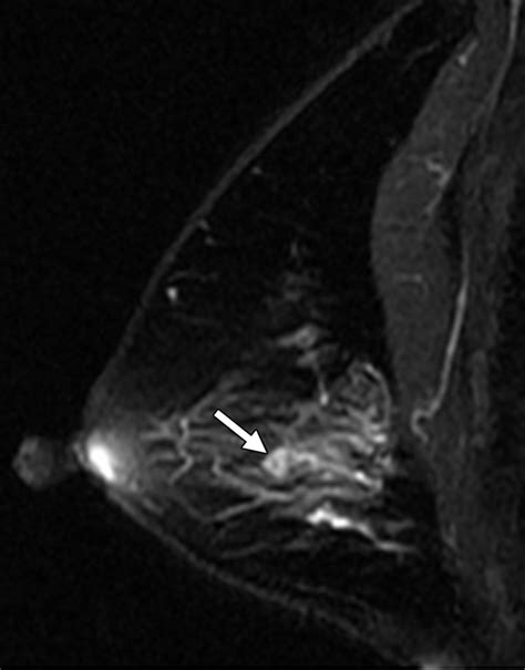 Solitary Intraductal Papillomas of the Breast: MRI Features and Differentiation From Small ...