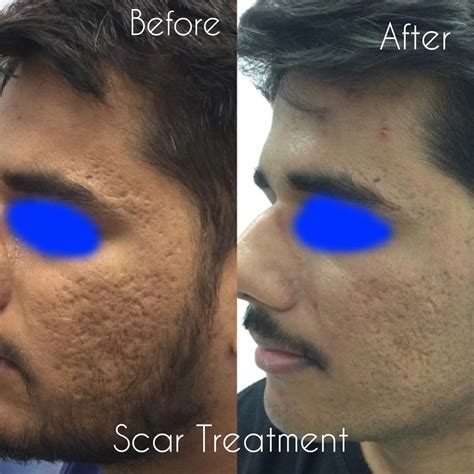 Best Acne Scars Treatment in Kolkata - Cost, Procedures & Results - La Derma