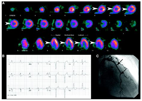 Medication and ECG Patterns That May Hinder SPECT Myocardial Perfusion ...