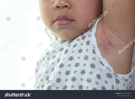 Itchy Rash Under Armpit Toddler at Keith Flores blog