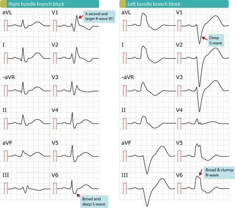 Right bundle branch block (RBBB): ECG, criteria, definitions, causes ...