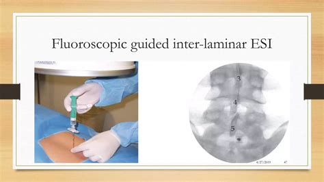 Injection Back Pain 的图像结果
