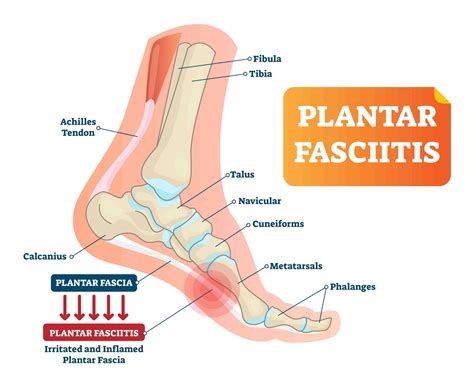 Foot or Heel Pain? It Might Be Plantar Fasciitis - Healthy You