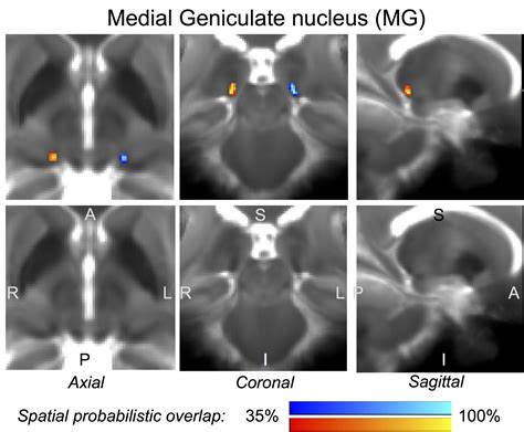 Medial Geniculate Nucleus Mri