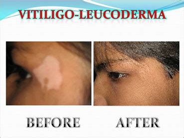 Best Homeopathic Doctor in Noida-Contact (+91- 9810486760)-Dr Suresh ...