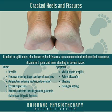 Cracked Heels and Fissures - Brisbane Physiotherapy & Podiatry