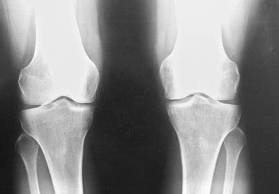 What Are the Treatments for Knee Joint Space Narrowing? | LIVESTRONG.COM