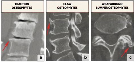 Disc Degeneration With Osteophyte Formation at Dorothy Boots blog