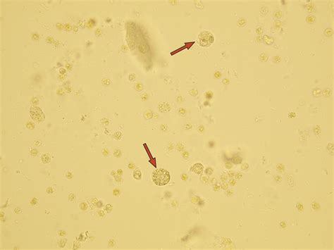 Leukocytes In Urine Pregnancy