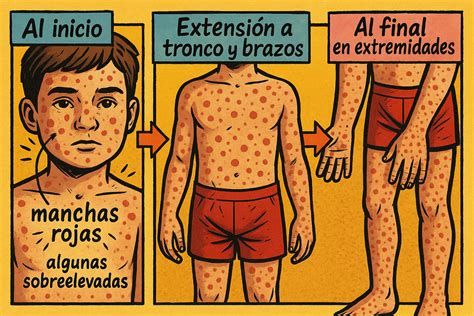 Sarampión en niños: síntomas, prevención y cuidado