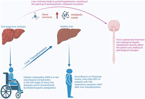 Liver Transplantation Reverses Hepatic Myelopathy in the Decompensated Phase of Cirrhosis: Case ...