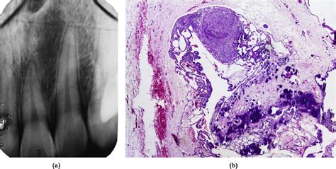 An international collaborative study of 105 new cases of adenomatoid odontogenic tumors - Oral ...