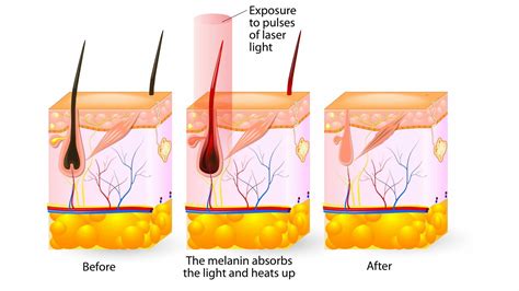 How Does Laser Hair Removal Work? - London Premier Laser & Skin Clinic
