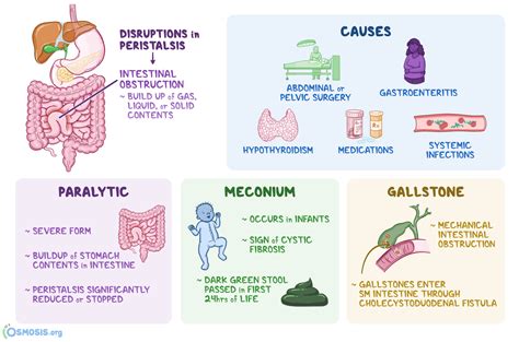 Ileus: What Is It, Types, Causes, Diagnosis, Treatment, and More | Osmosis
