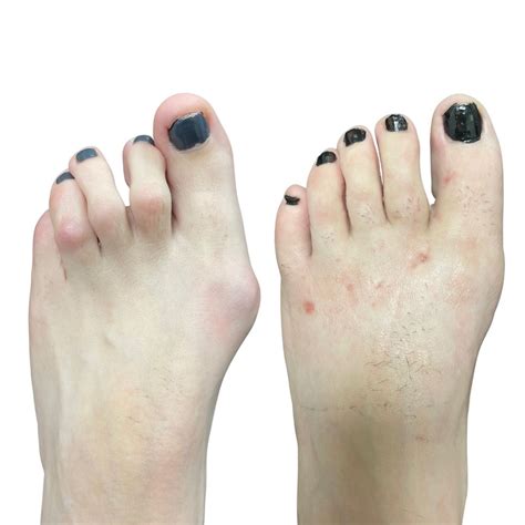 Hammer Toes Treatment