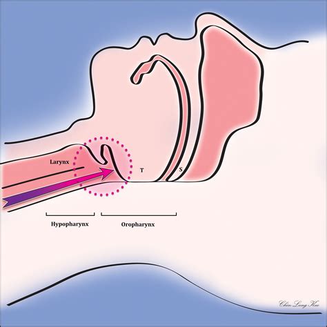 Laryngeal Esophageal Reflux Symptoms at Dana Cohen blog