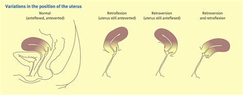 Anatomy of the uterus - Anaesthesia & Intensive Care Medicine