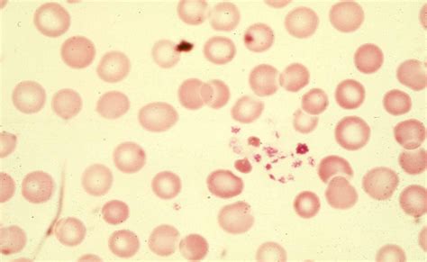 Low Platelets – Preserva Wellness