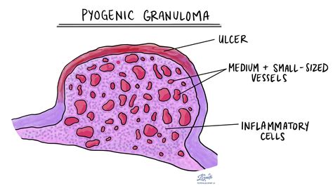 Oral Pyogenic Granuloma Histology Oral Pyogenic Granuloma—a Review