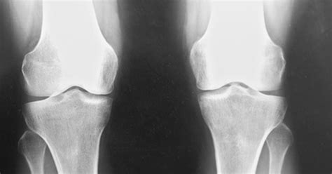 What Are the Treatments for Knee Joint Space Narrowing? | LIVESTRONG.COM