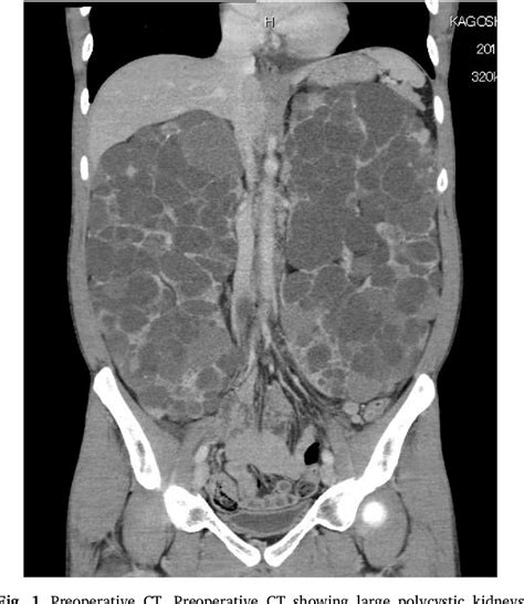 Image result for Simple Nephrectomy