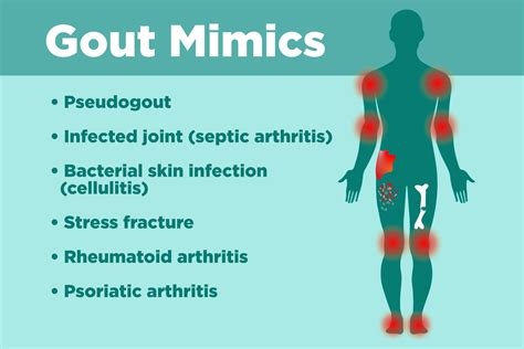 Pseudogout Arthritis