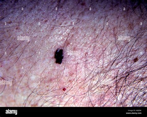 Non Cancerous Moles