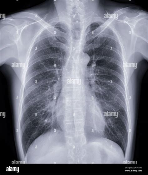 Chest X Ray Tb Vs Normal