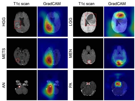 Brain Cancer Tumor Mri