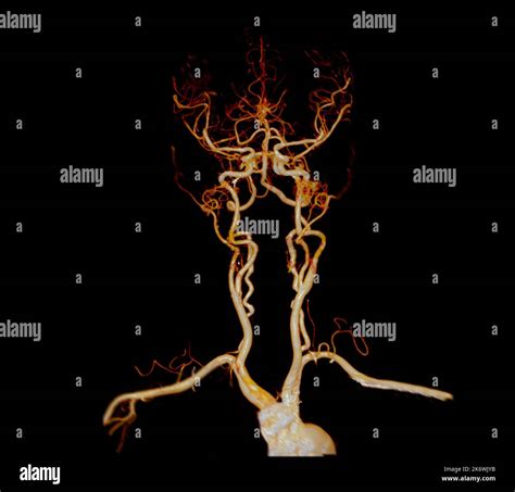 CTA brain or CT angiography of the brain 3D Rendering image for ...