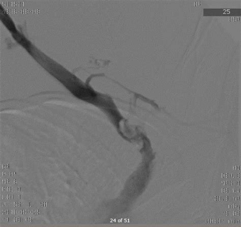 Paget Schroetter Syndrome