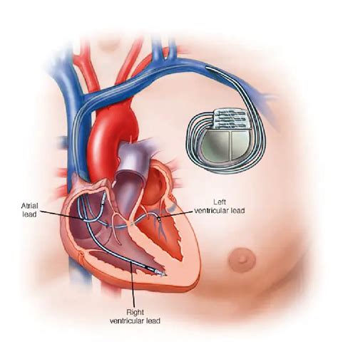 Pacemaker Procedure 的图像结果