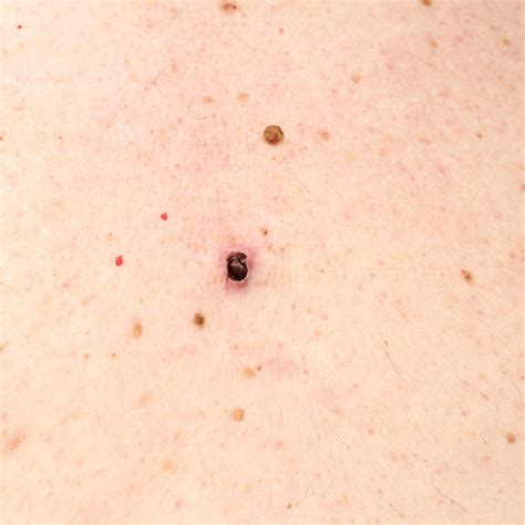 Blackheads On Back Removal