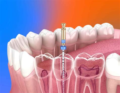 What is a Tooth Crown? Dental crown procedure - Toronto Dental Clinic