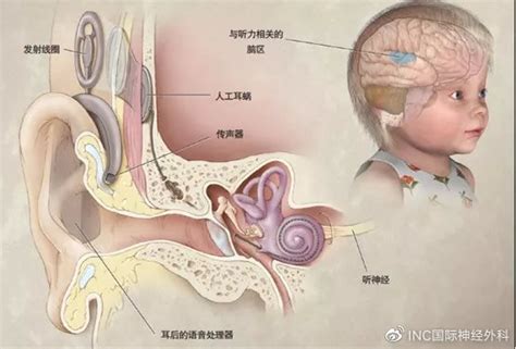 影响听神经瘤患者听力的四大因素与保护及重建听力的两个原则__中国医疗
