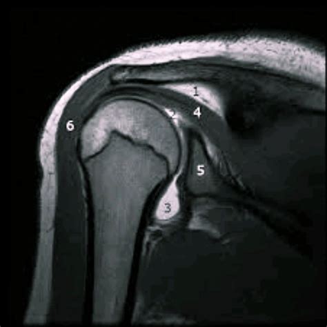 Mr Arthrogram Shoulder 的图像结果