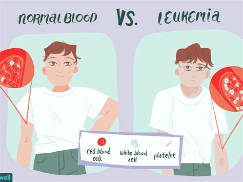 Leukemia Patients Life Expectancy