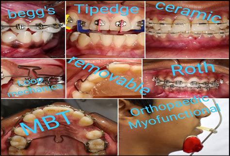Department of Orthodontics and Dentofacial Orthopedics- Bhabha ...