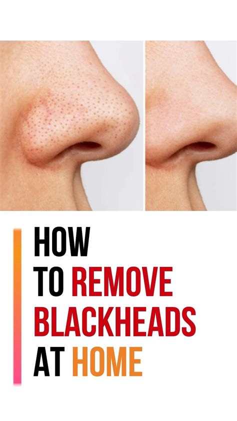 How do you get rid of deep blackheads naturally – Artofit