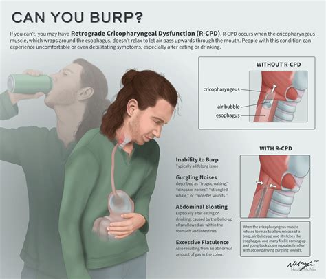 I created medical illustrations for R-CPD : r/noburp