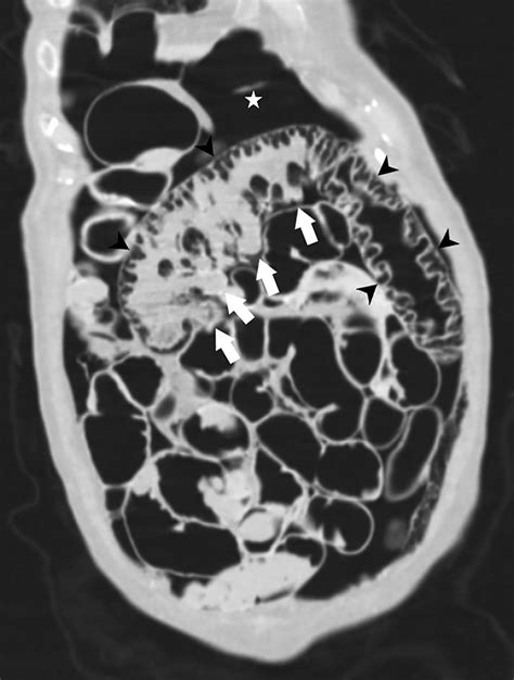 Pneumatosis Cystoides Intestinalis | Applied Radiology